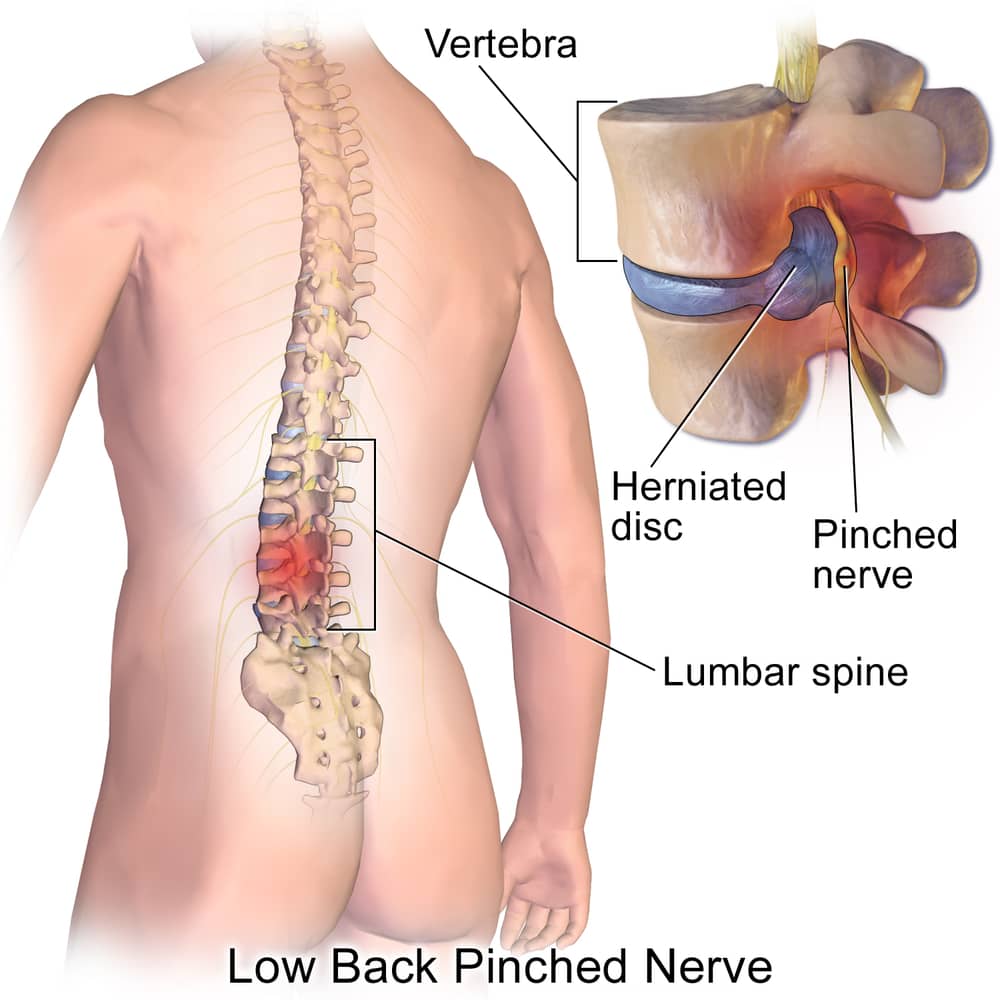 low back pinched nerve